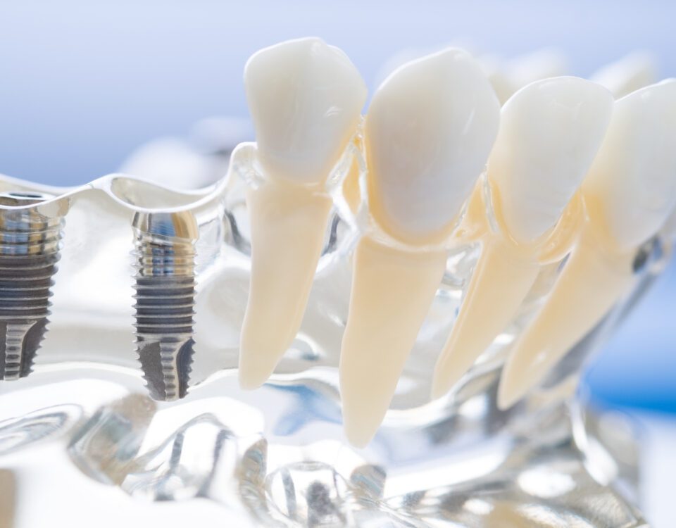 Benefits of Modern Dental Implants